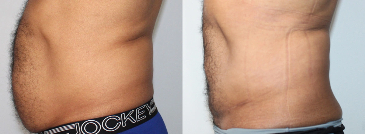 Before and After Plastic Surgery Results | CraftMD Scottsdale & Phoenix, AZ