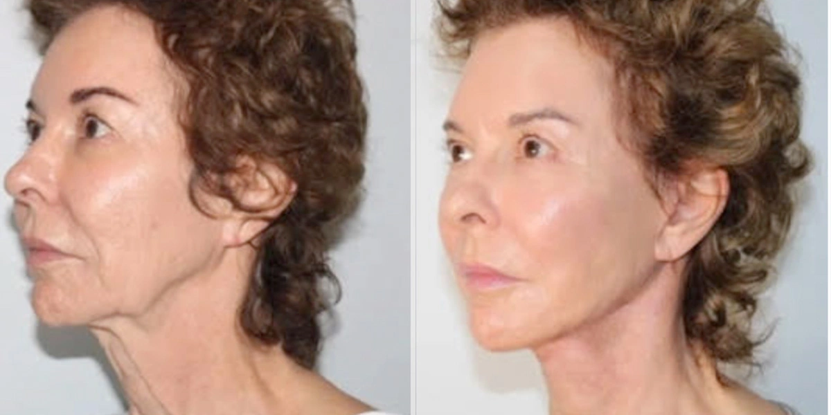 Before and After Plastic Surgery Results | CraftMD Scottsdale & Phoenix, AZ
