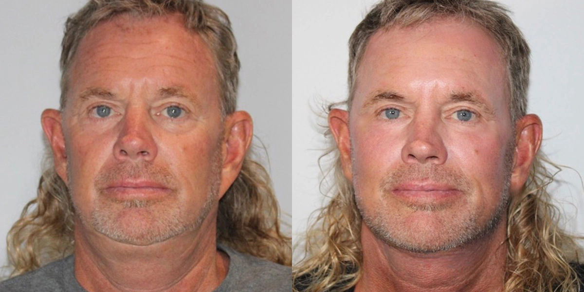 Before and After Plastic Surgery Results | CraftMD Scottsdale & Phoenix, AZ