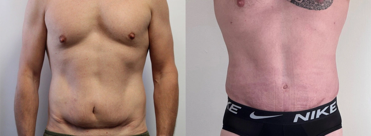 Before and After Plastic Surgery Results | CraftMD Scottsdale & Phoenix, AZ