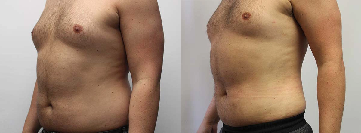 Before and After Plastic Surgery Results | CraftMD Scottsdale & Phoenix, AZ