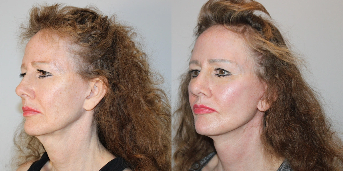 Before and After Plastic Surgery Results | CraftMD Scottsdale & Phoenix, AZ