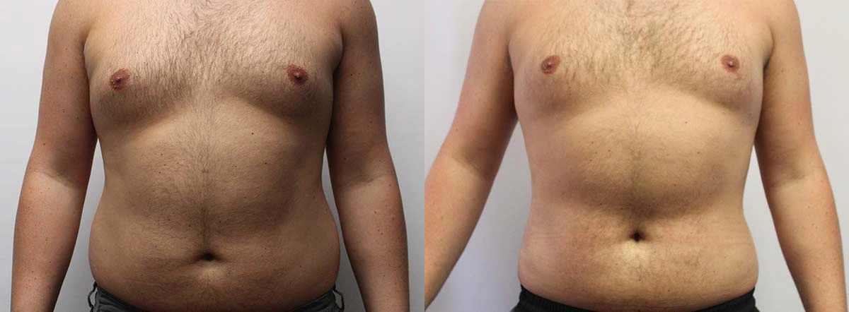 Before and After Plastic Surgery Results | CraftMD Scottsdale & Phoenix, AZ