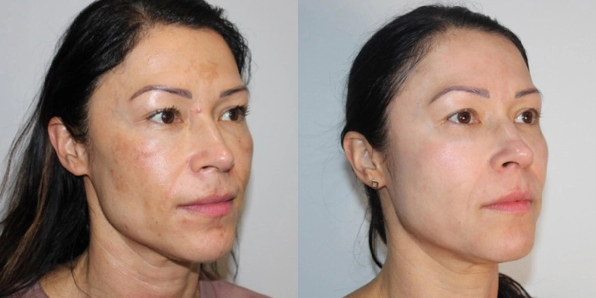 Before and After Plastic Surgery Results | CraftMD Scottsdale & Phoenix, AZ