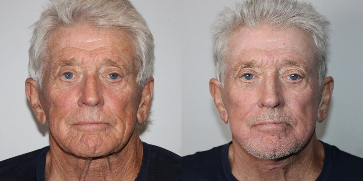 Before and After Plastic Surgery Results | CraftMD Scottsdale & Phoenix, AZ