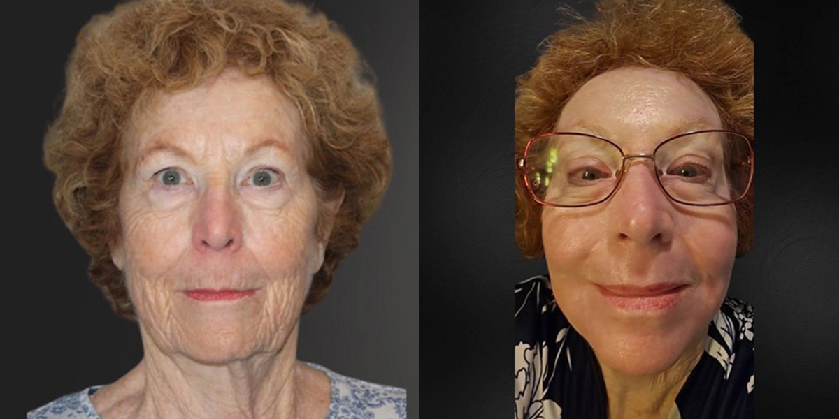 Before and After Plastic Surgery Results | CraftMD Scottsdale & Phoenix, AZ