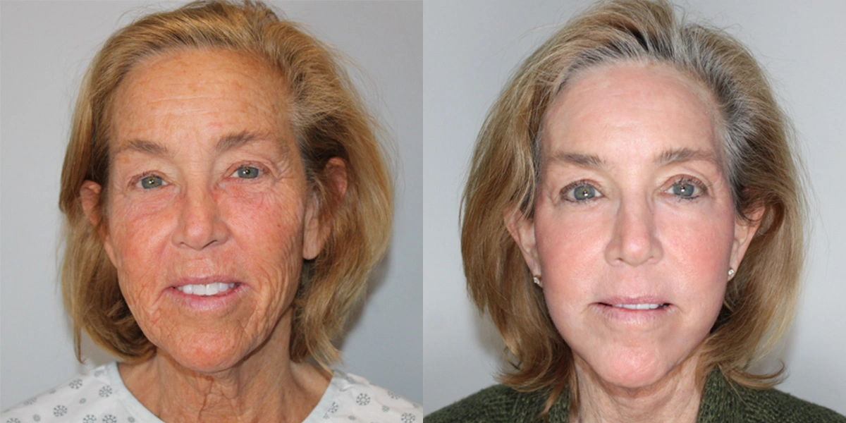 Before and After Plastic Surgery Results | CraftMD Scottsdale & Phoenix, AZ