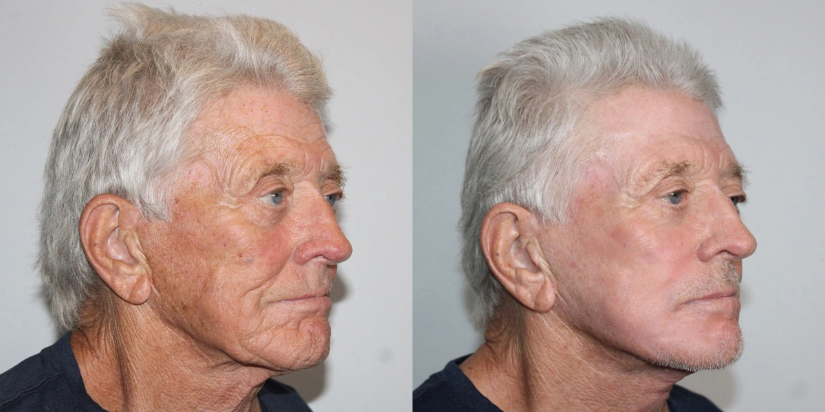 Before and After Plastic Surgery Results | CraftMD Scottsdale & Phoenix, AZ