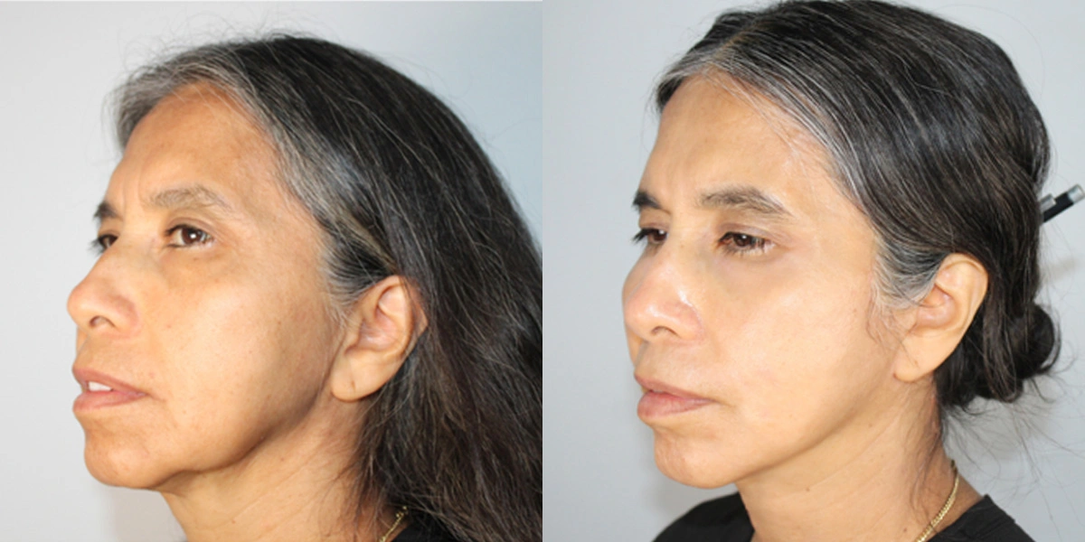 Before and After Plastic Surgery Results | CraftMD Scottsdale & Phoenix, AZ