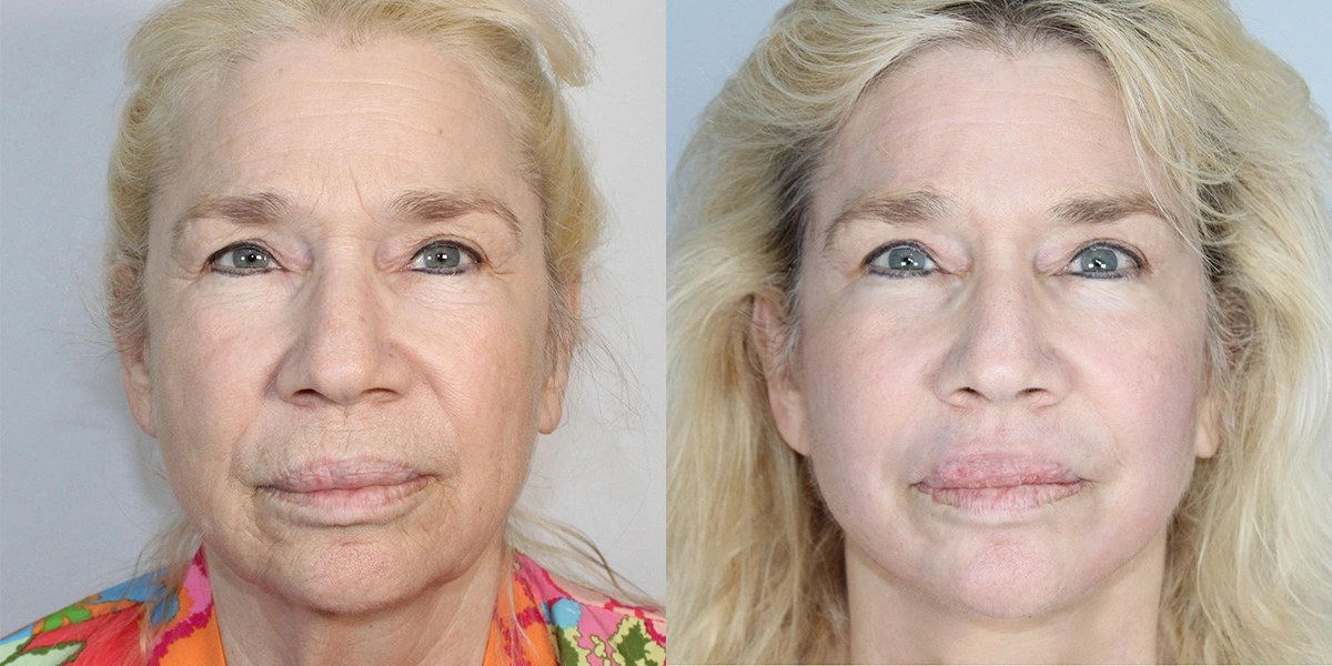 Before and After Plastic Surgery Results | CraftMD Scottsdale & Phoenix, AZ