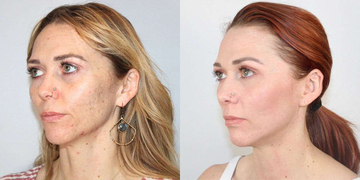 Before and After Plastic Surgery Results | CraftMD Scottsdale & Phoenix, AZ