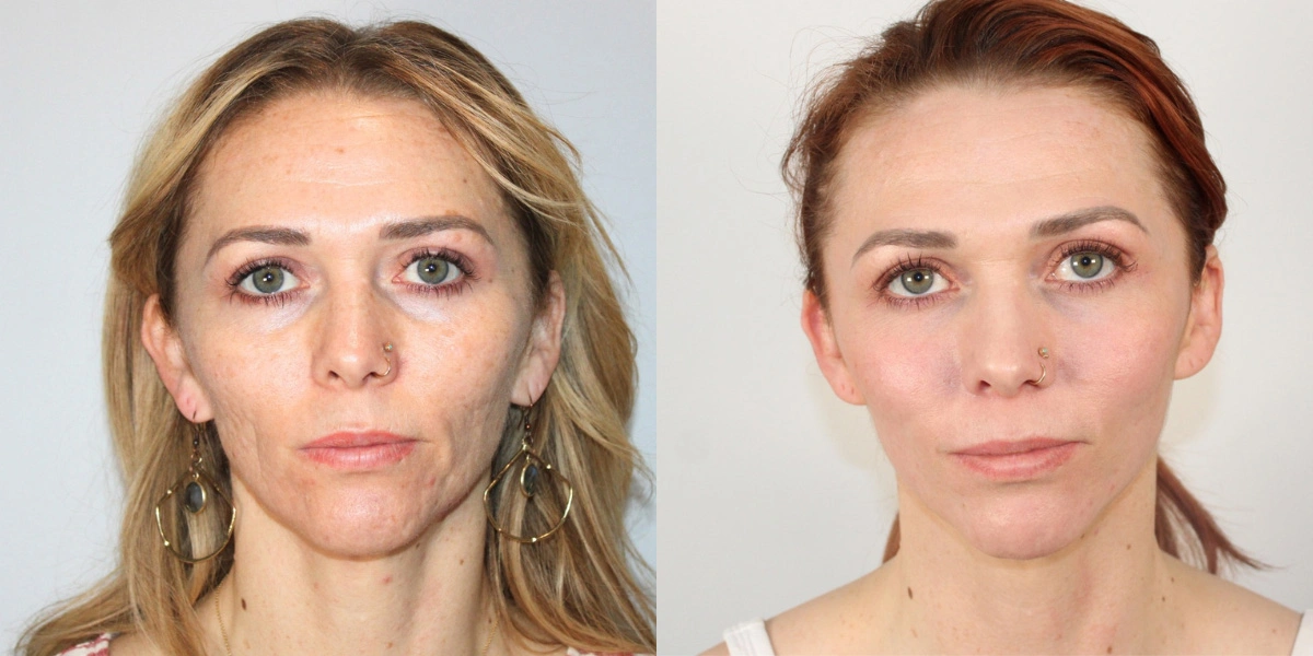 Before and After Plastic Surgery Results | CraftMD Scottsdale & Phoenix, AZ