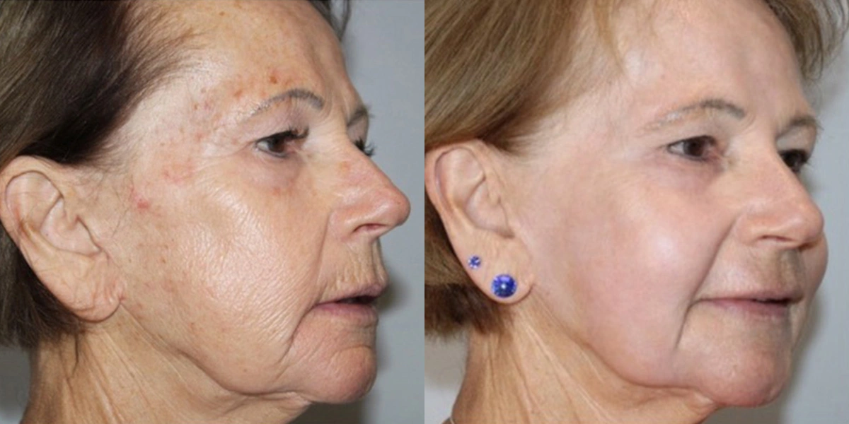 Before and After Plastic Surgery Results | CraftMD Scottsdale & Phoenix, AZ