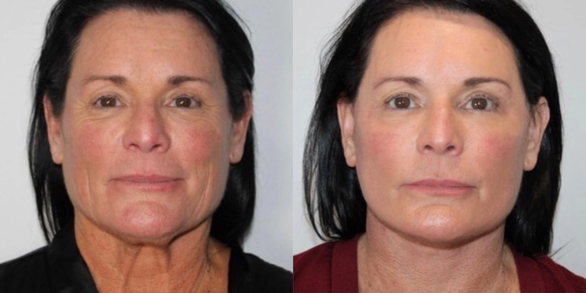 Before and After Plastic Surgery Results | CraftMD Scottsdale & Phoenix, AZ