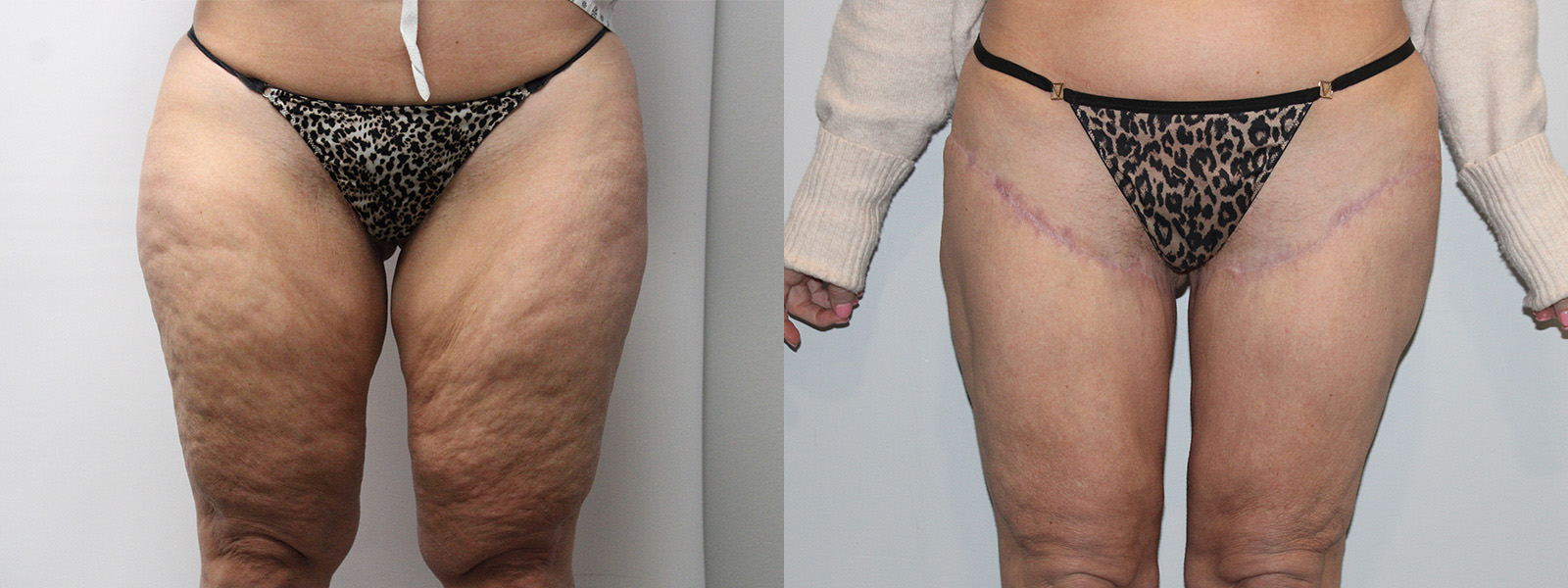 6074-thighL-p01-1