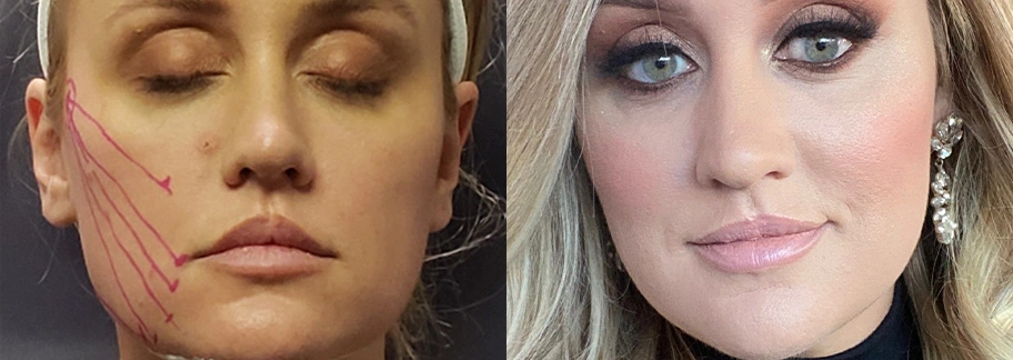 Before and After Plastic Surgery Results | CraftMD Scottsdale & Phoenix, AZ