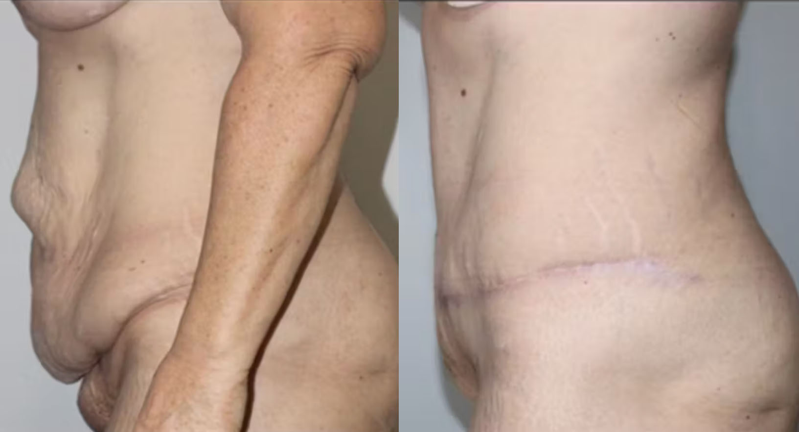 tummy-tuck-case123-2