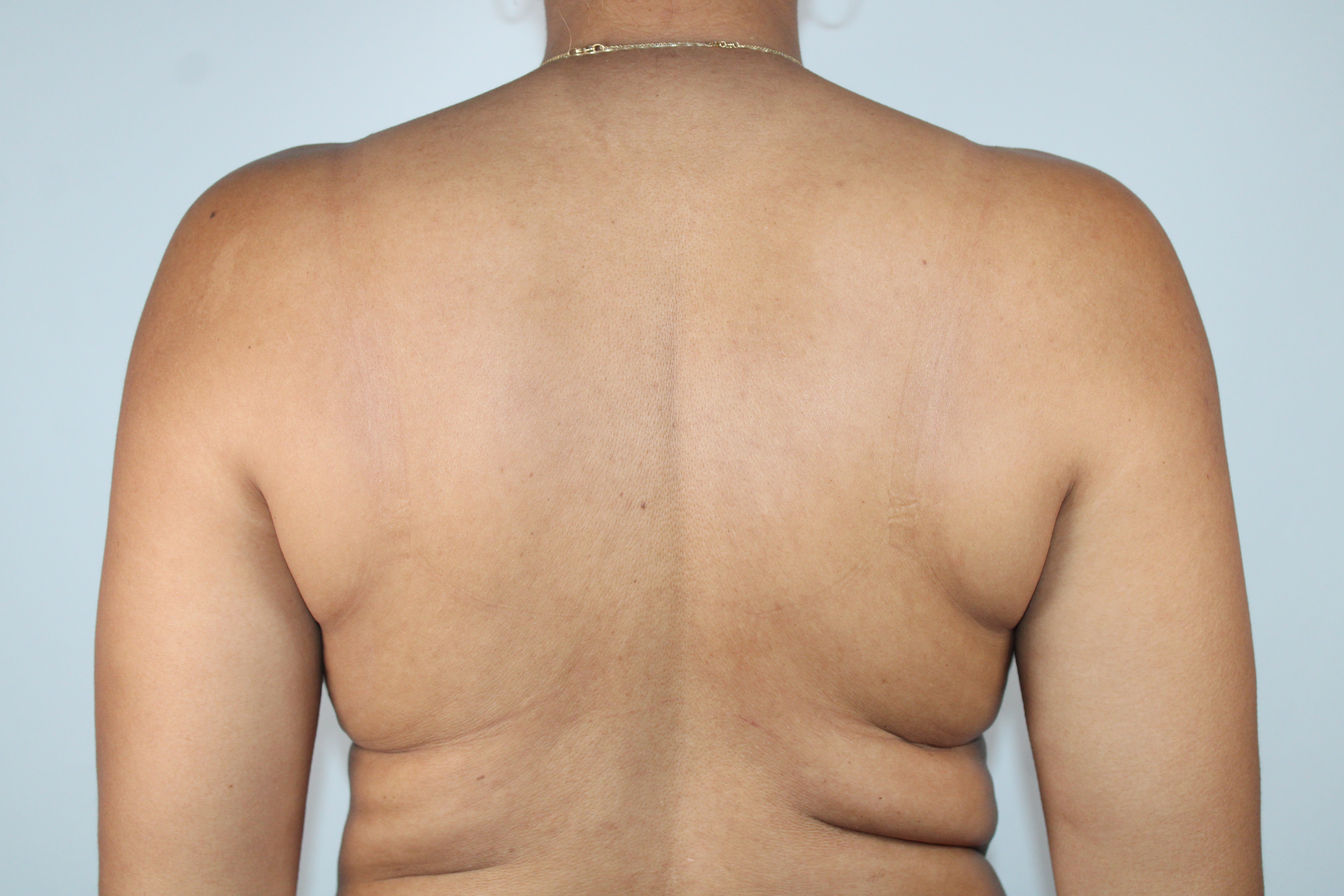 Before and After liposuction and Renuvion midback